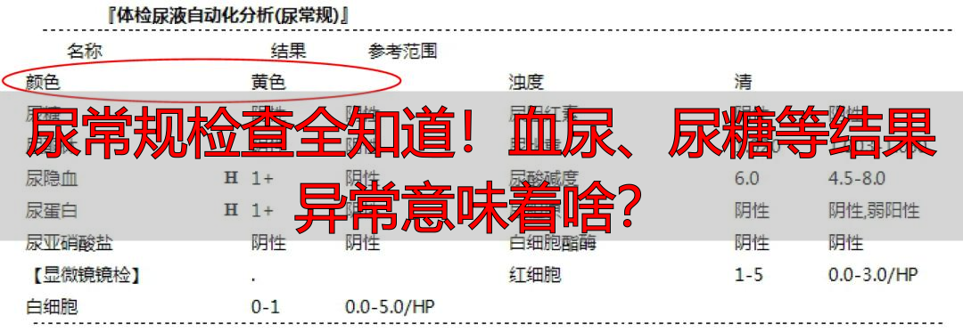 尿常规检查全知道！血尿、尿糖等结果异常意味着啥？