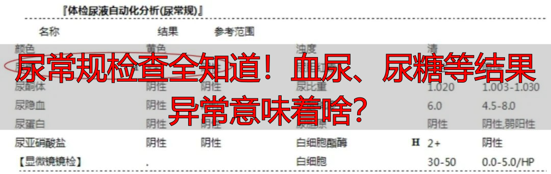 尿常规检查全知道！血尿、尿糖等结果异常意味着啥？