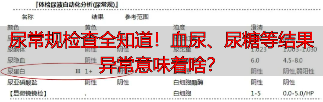 尿常规检查全知道！血尿、尿糖等结果异常意味着啥？