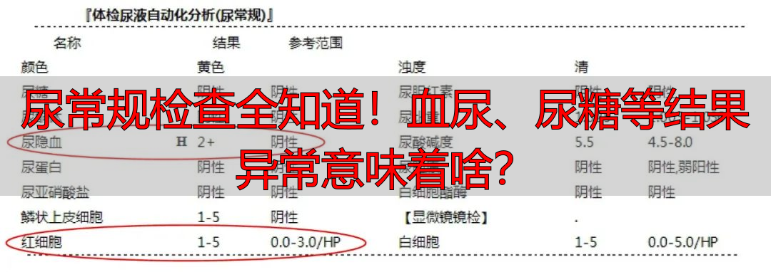 尿常规检查全知道！血尿、尿糖等结果异常意味着啥？