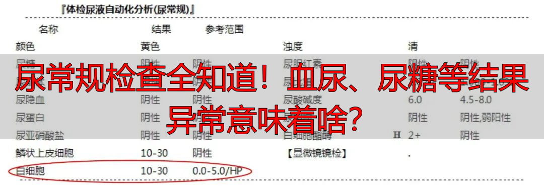 尿常规检查全知道！血尿、尿糖等结果异常意味着啥？